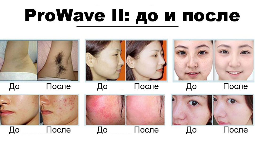 prowave-ii-diodnyy-lazer-808-elight-08